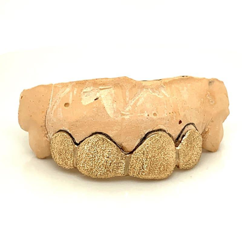4pc Gold Diamond Dust Top Grillz - Seattle Gold Grillz