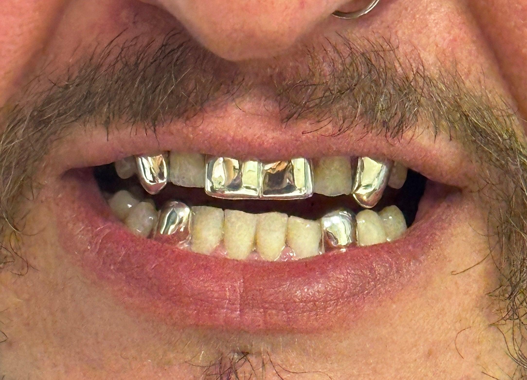4 top 2 bottom Silver Grillz
