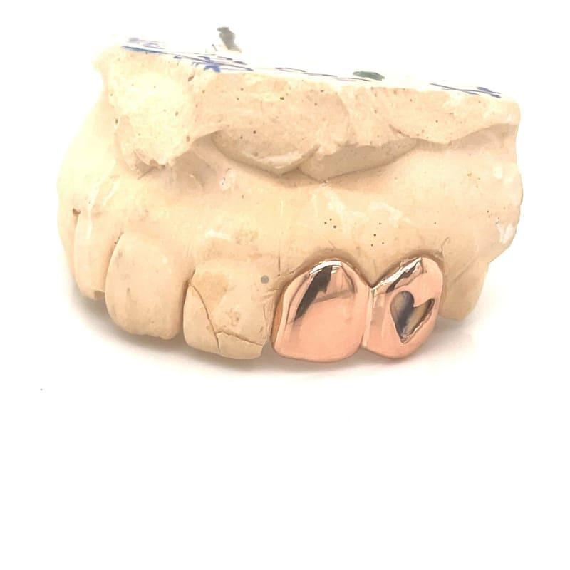 2pc Rose Gold Open Face Grillz - Seattle Gold Grillz